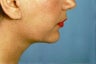Chin Liposuction - Before & After