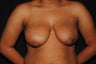 19 year old woman dissatisfied with her saggy breasts