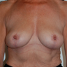 65 years old - Mastopexy / Breast Uplift