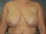 Breast Lift