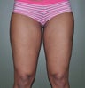 32 Year Old Female Treated For Saddle Bags