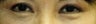 Revision Bilateral Asian Eyelid Surgery