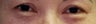 Revision Bilateral Asian Eyelid Surgery