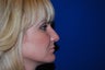 Rhinoplasty