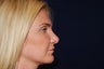Rhinoplasty