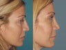 Female Patient, Revision Rhinoplasty