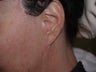 Before and after revision midfacelift