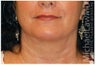 Lower Facial Rejuvenation