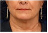 Lower Facial Rejuvenation