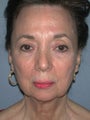 Brow Lift