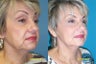 Lines around mouth treated with Juvederm