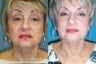 Lines around mouth treated with Juvederm
