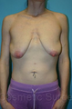 Breast Lift