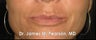 Lip Enhancement
