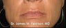 Lip Enhancement