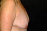 Breast Lift