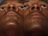 Rhinoplasty