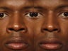 Rhinoplasty