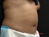 Coolsculpting