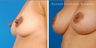 Nipple reduction and reshaping