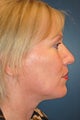 Nose Surgery