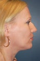 Nose Surgery