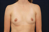 Breast Augmentation