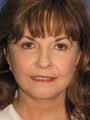 51 Year Old Female FaceLift
