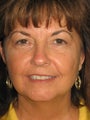51 Year Old Female FaceLift