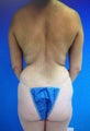 PRP Assisted Fat Grafting Brazilian Butt Lift