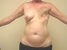 Breast Reconstruction after mastectomy