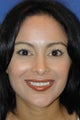 Female Tip Rhinoplasty