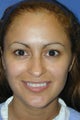 Female Tip Rhinoplasty