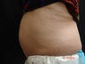 Coolsculpting