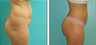 Liposuction Before & After