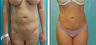 Liposuction Before & After