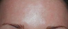 Botox