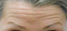 Botox