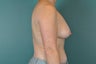 Breast Lift