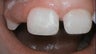 Filling to Repair Broken Tooth