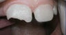 Filling to Repair Broken Tooth