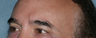Male Patient Has Fraxel Repair Around Eyes