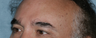Male Patient Has Fraxel Repair Around Eyes