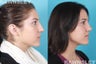 Revision Rhinoplasty