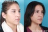 Revision Rhinoplasty