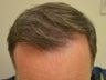 55 year old male 7 months after receiving 1400 1-4 hair follicular units