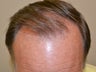 55 year old male 7 months after receiving 1400 1-4 hair follicular units
