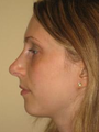 Nose Surgery