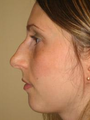 Nose Surgery