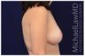 Breast Lift
